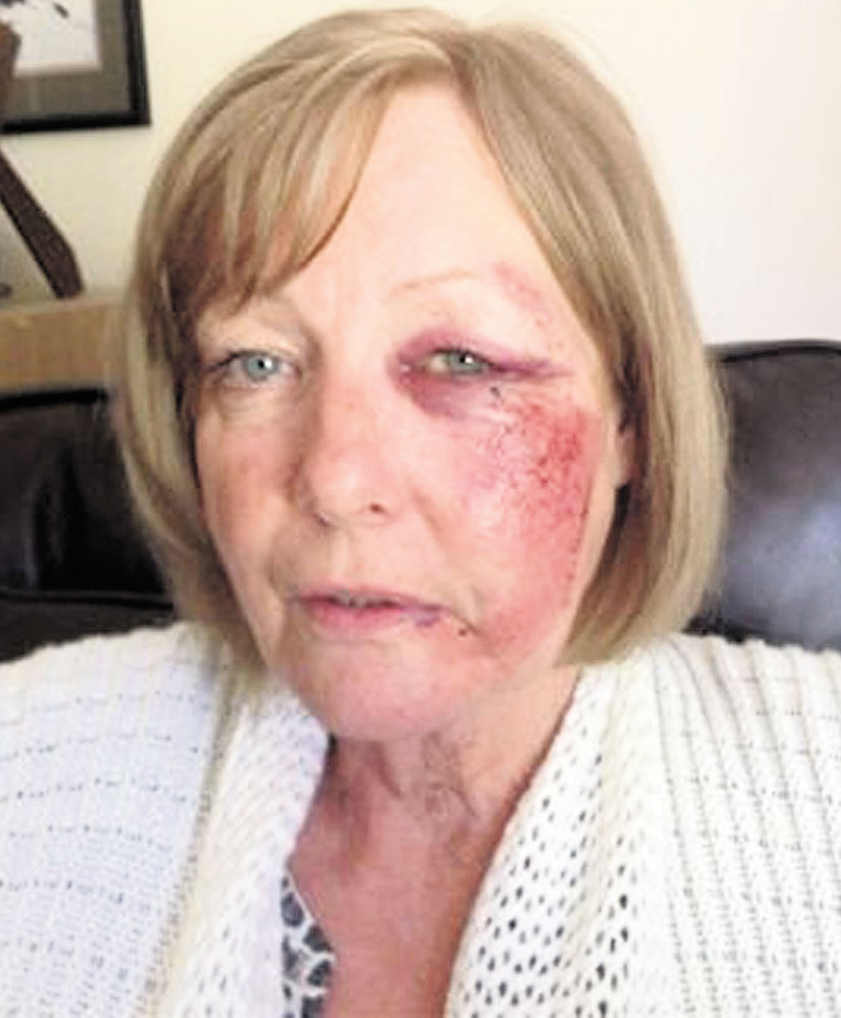 Undy gran left with horrific facial injuries after attack outside Severn Bridge Club in Chepstow - 2521056